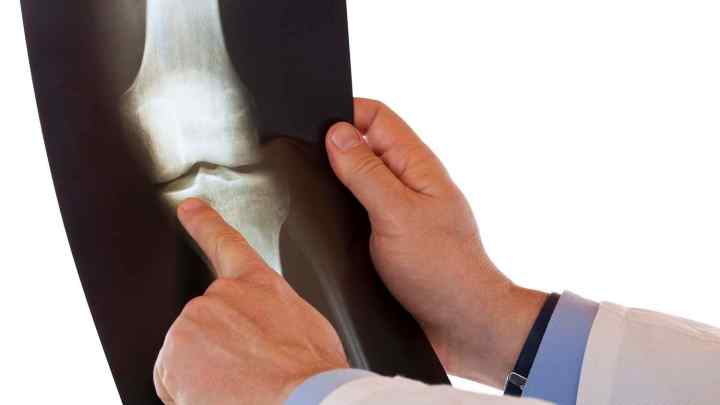 Хвороба Гоффа колінного суглоба: симптоми, лікування